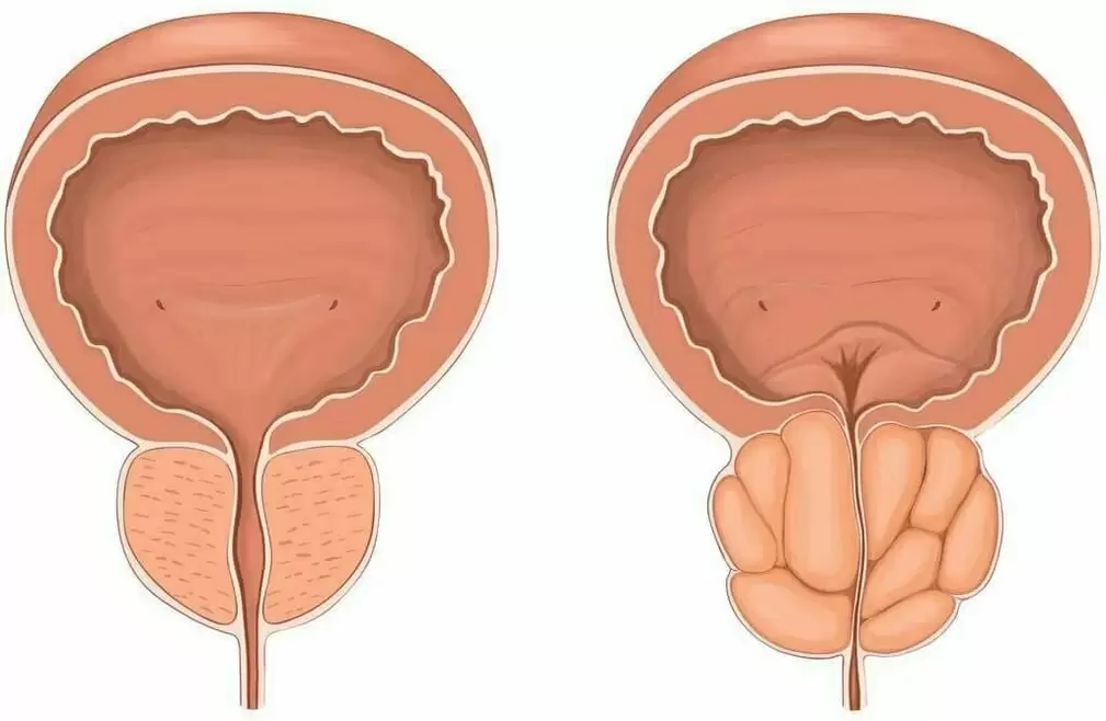 A healthy prostate gland and prostatitis