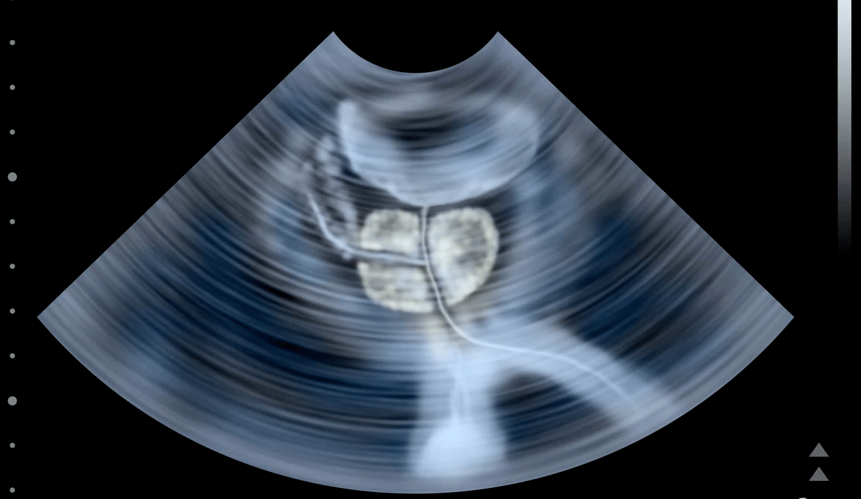 Ultrasound checks for prostatitis caused by stones