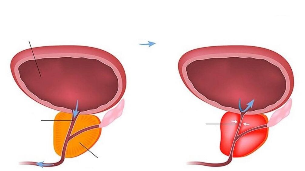 the prostate gland is normal and inflamed